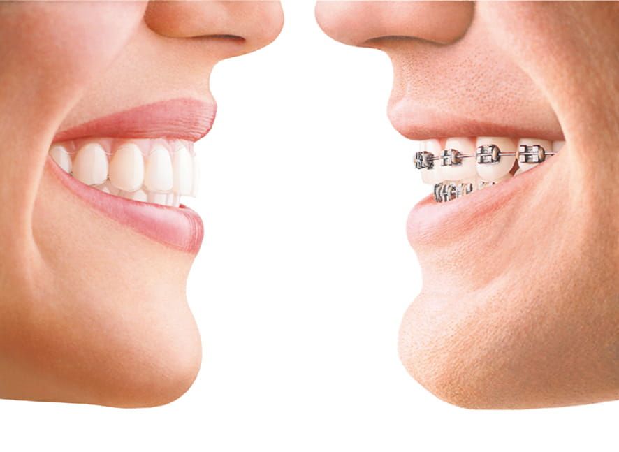 Braces