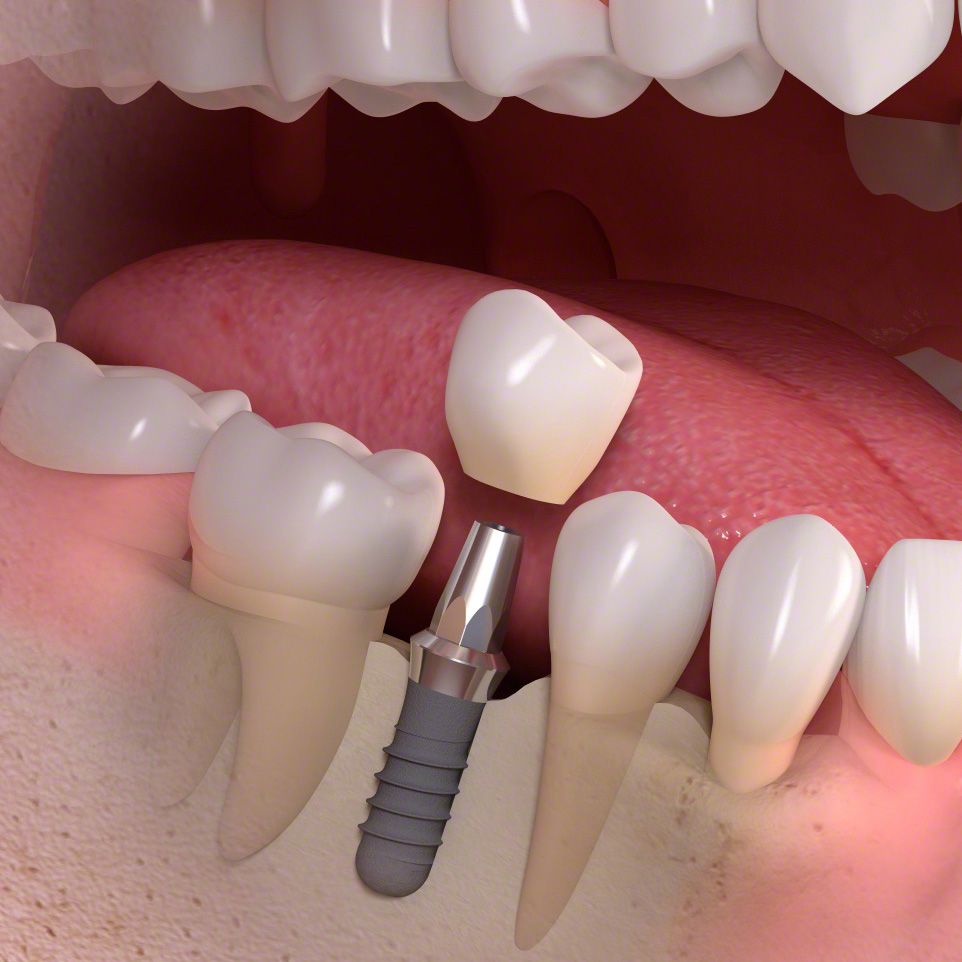 Implants
