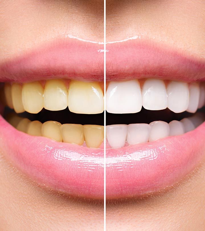 Whitening