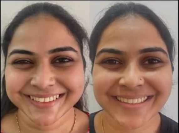 Invisalign Transformation