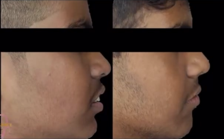 Before After Treatment